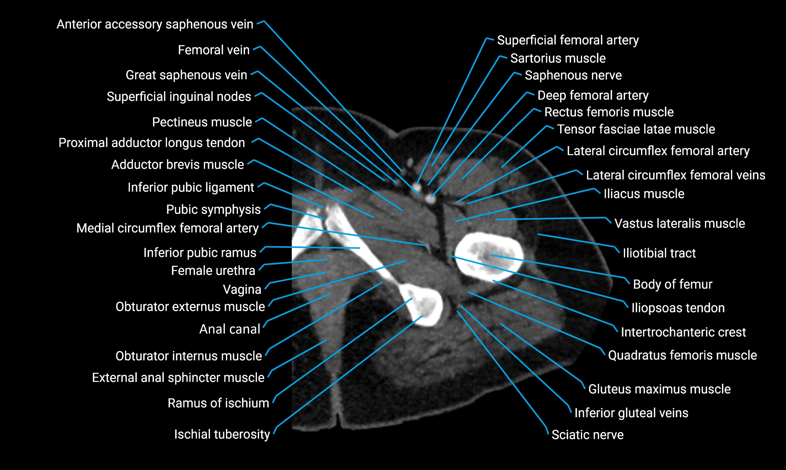 CT lower limb axial cross sectional anatomy labelled image 15 (2).webp